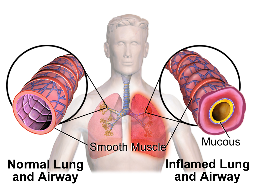 Bronchial-Asthma-HealthConsultants.in